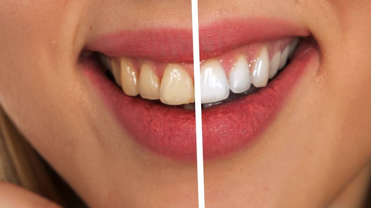 limpieza dental vr limpieza dental profunda